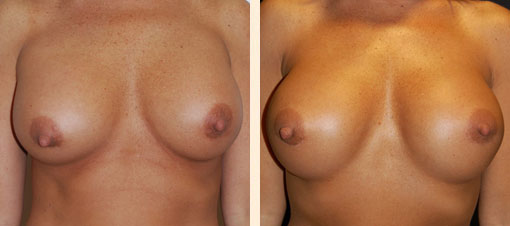 Breast Implant Revision Before and After 01