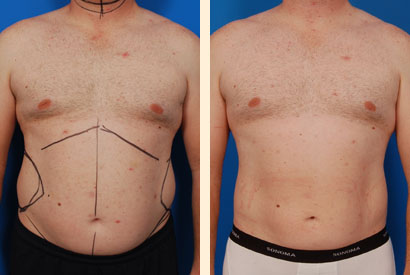 Liposuction For Men Before and After 01