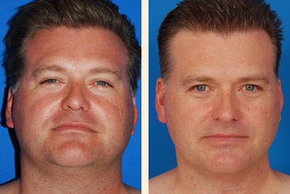 Liposuction For Men Before and After 01