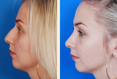 Rhinoplasty Before and After 01