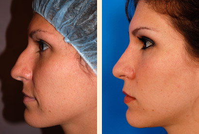Rhinoplasty Before and After 01