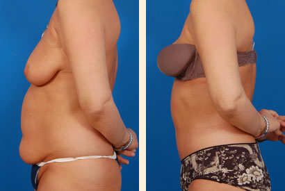 Abdominoplasty Before and After 22