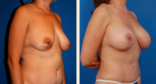 Breast Lift Before and After 11