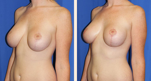 Breast Lift Before and After 15